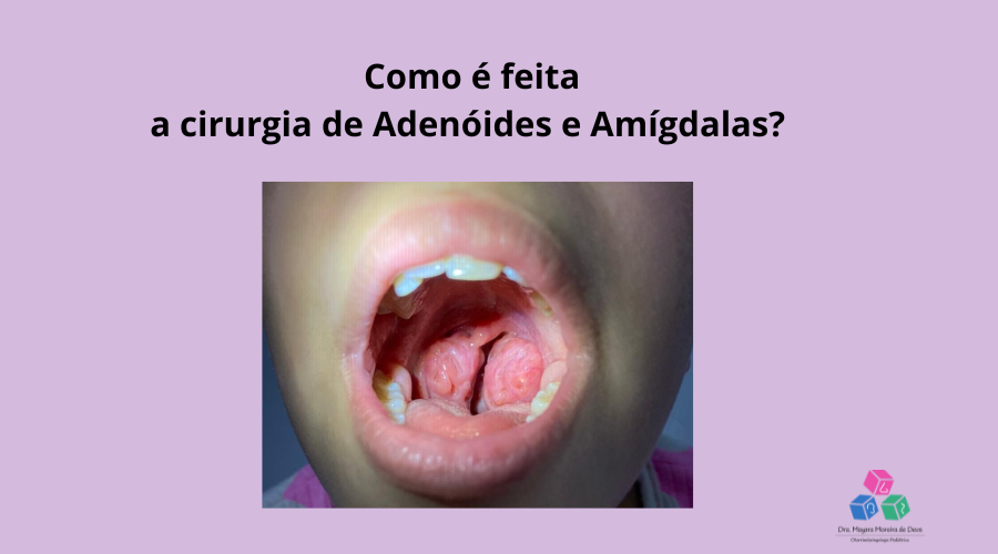 Como é a cirurgia de adenoide e amígdalas?