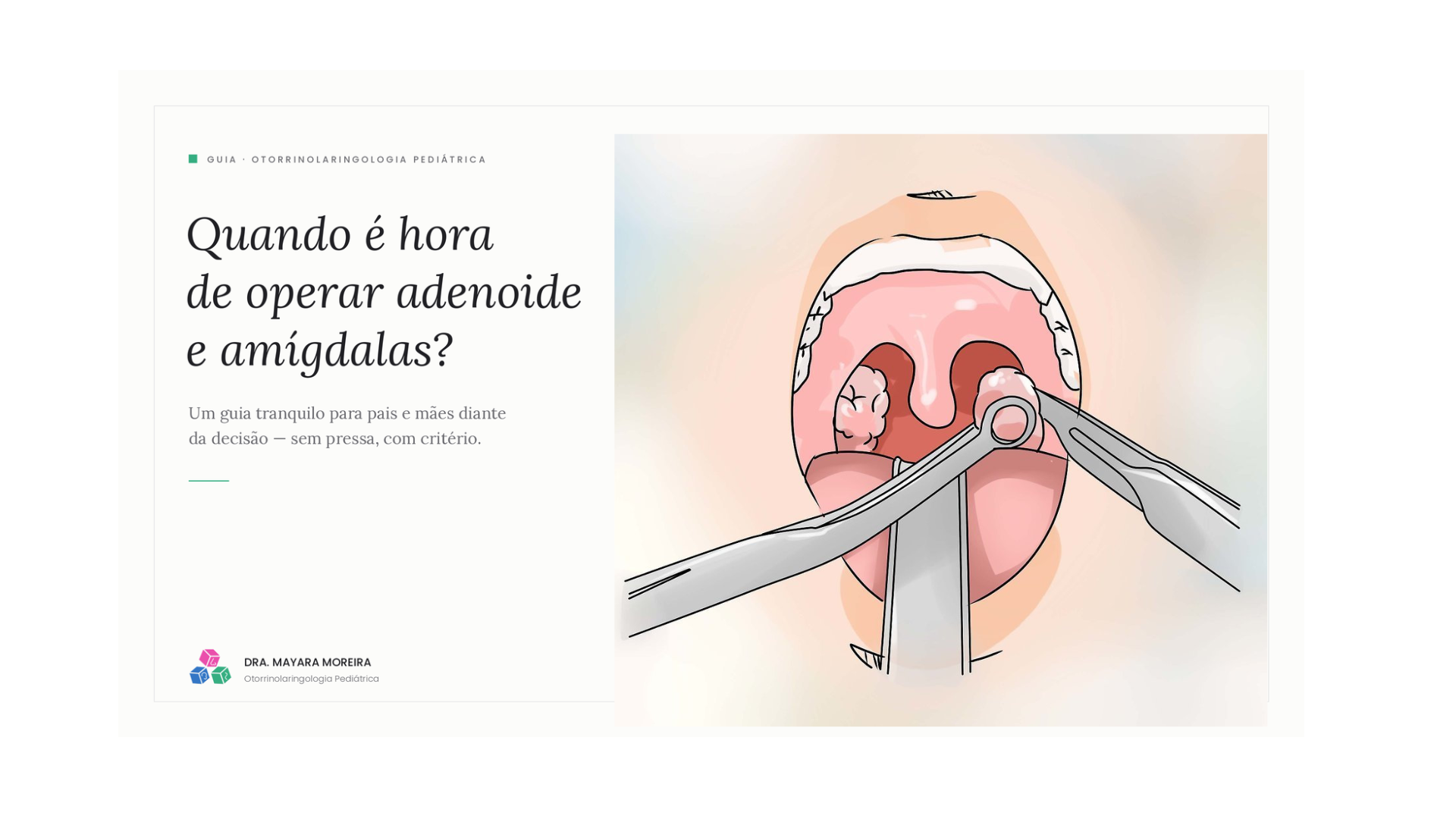 Quando é hora de operar adenoide e amígdalas?